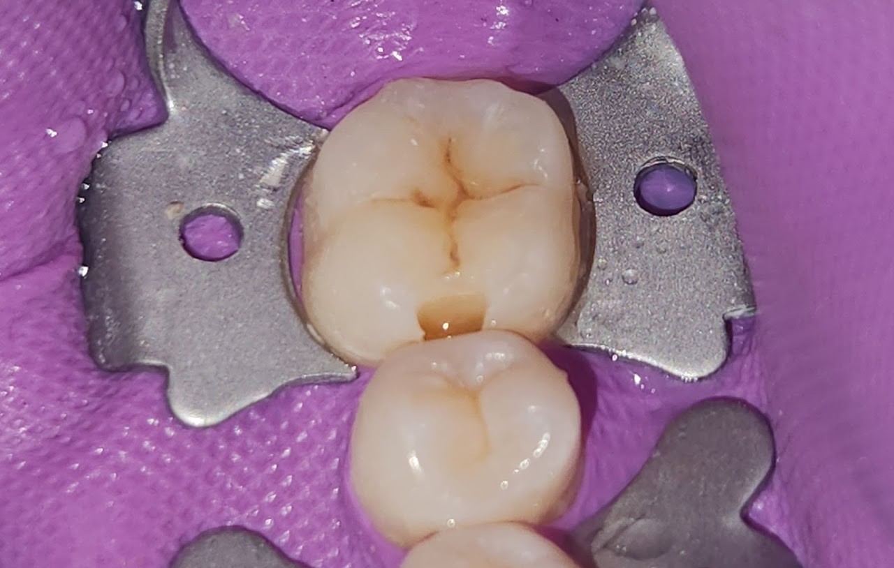 Microscope Root Canal